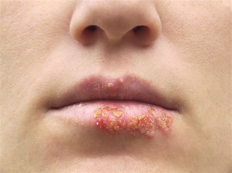 Obat Penyakit Herpes Di Apotik - Perumperindo.co.id
