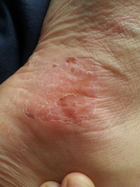 Eczema Feet Itchy at John Sigel blog
