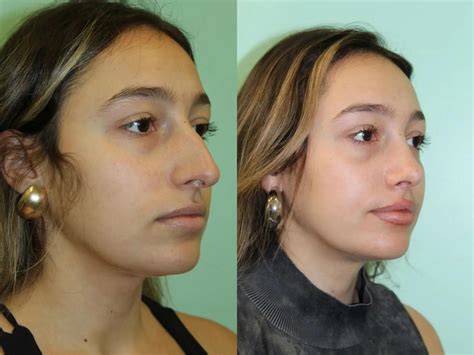 Female Rhinoplasty Before and After Pictures Case 1085 | Tampa, FL