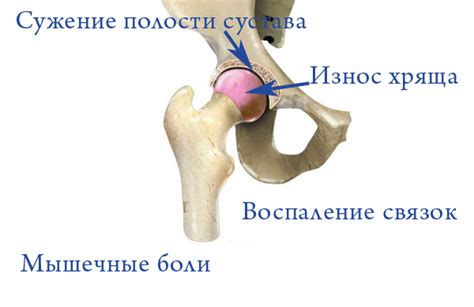 Лечение боли в тазобедренном суставе: к какому врачу обратиться, методы ...