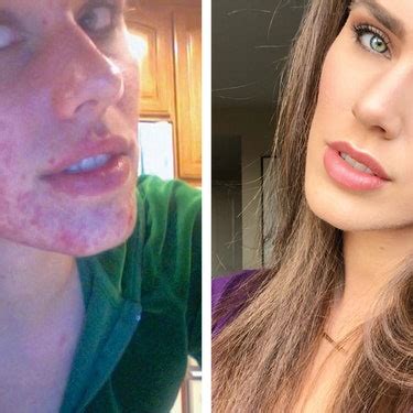 Cassandra Bankson on the Truth Behind Her Cystic Acne | Teen Vogue