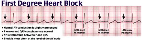 Heart block causes, symptoms, types, diagnosis and heart block treatment