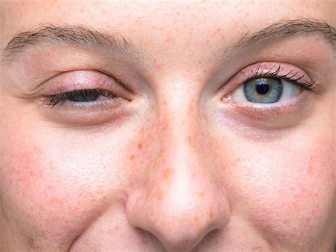 15 Amazing Facts About Myasthenia Gravis