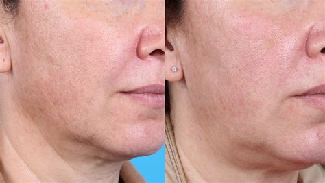PRP for Face - VIP Plastic Surgery