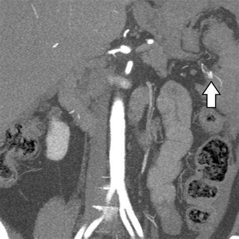 Rupture of Splenic Artery Aneurysm Which Was Located Distally ...