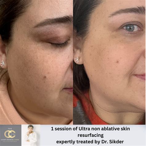 Skin Resurfacing: Pigmentation & Skin Health Solutions | Edmonton, AB
