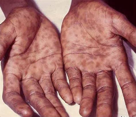 syphilis  prevention risk factors