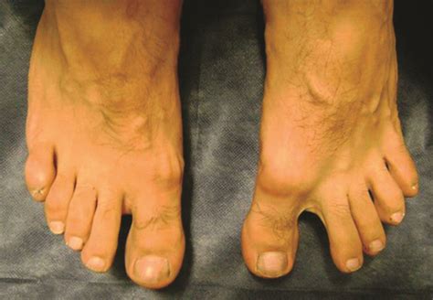 weakness   intrinsic foot muscles  demonstrated   lack