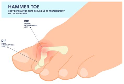 Understanding Hammer Toes – Cottonique - Allergy-free Apparel