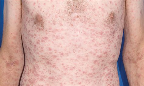 medical term  rash   body  bruce lohr blog