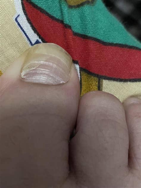 Toenail Fungus or Melanoma? : r/Dermatology