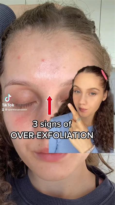 How to heal over exfoliated skin fast • 5 steps – Artofit