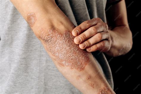 acute psoriasis   elbows   autoimmune incurable dermatological