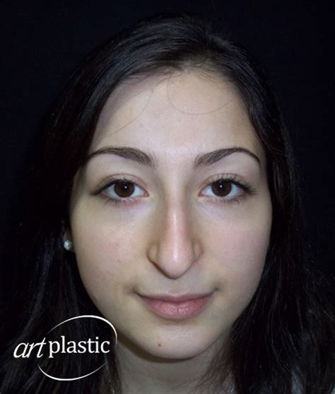 Большой, горбатый нос / Фото / Альбом №50 | Клиника Art-Plastic