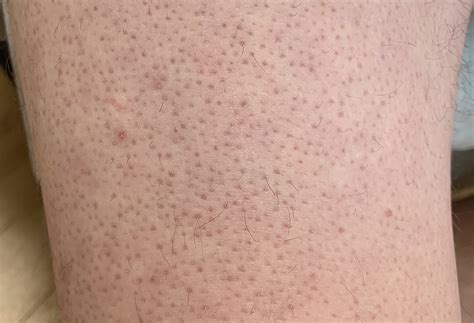 File:Keratosis Pilaris on Lower Extremity.jpg - Wikimedia Commons