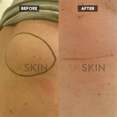 private lipoma cyst removal surgery ukskin