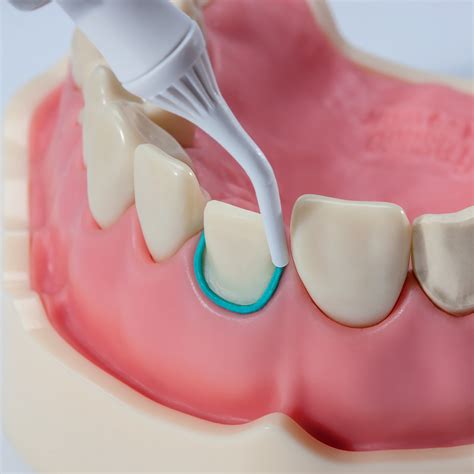 Best Gingival Retraction Paste at Elizabeth Case blog