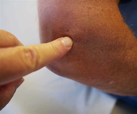 Tennis Elbow (Lateral Epicondylitis) - OrthoInfo - AAOS