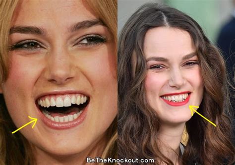 Keira Knightley Before And After Nose Job
