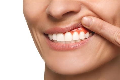 how to heal infected gums at home