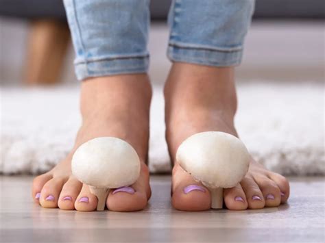 Tipos De Hongos En Los Pies