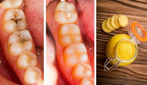 How to Heal Cavities and Tooth Decay Naturally with These Home Remedies