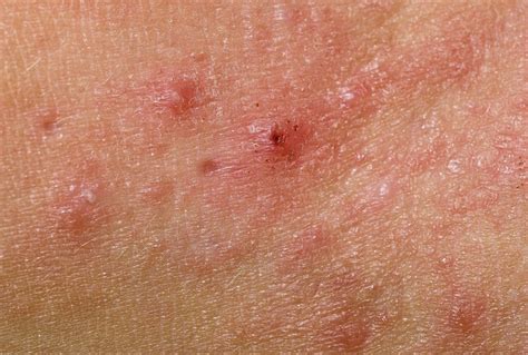 Mrsa Symptoms