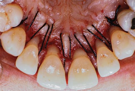 Application of a papillary retention flap