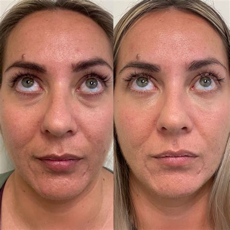 surgical face lift portland oregon  sandra slavin blog