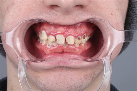 Sore Gums: Symptoms, Causes, and Treatments - Maltepe Dental Clinic
