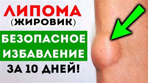 Липома! Чтобы быстро избавиться от жировика, возьмите обычное... 🌳 ...
