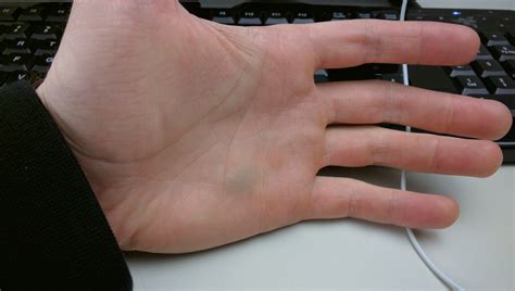 What's wrong with my hand? (bruise on palm, left of ringfinger/pinky