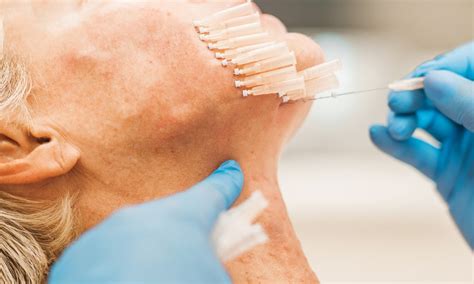 care   skin pdo thread lift aftercare