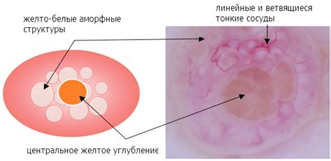 Контагиозный моллюск - Клинические рекомендации