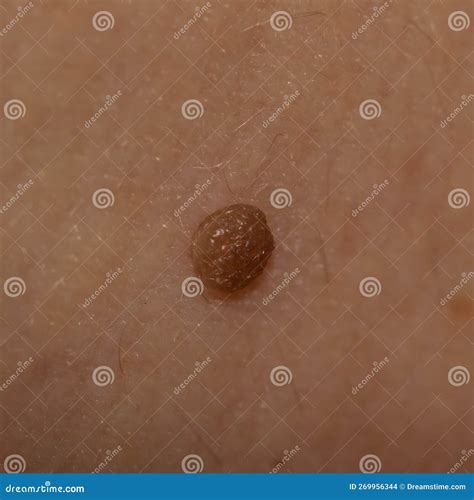 Large Mole Close-up. Macro Shot Of Benign Skin Lesion On Caucasian