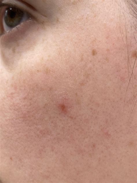 Face Rash Not Going Away at Nilsa Sutton blog