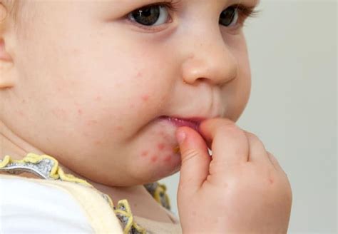 Comprendre la maladie mains-pieds-bouche chez l'enfant et ses symptômes