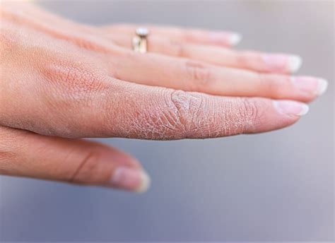Dyshidrotic Eczema: Causes, Treatments And Prevention, 46% OFF