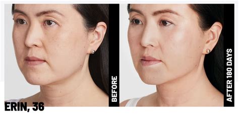 Ulthera Skin Tightening | Ethemba Health and Image Centres