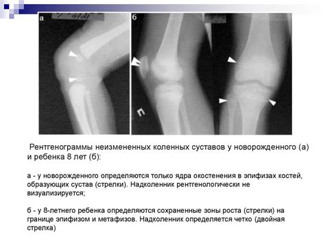 Костный возраст - презентация онлайн