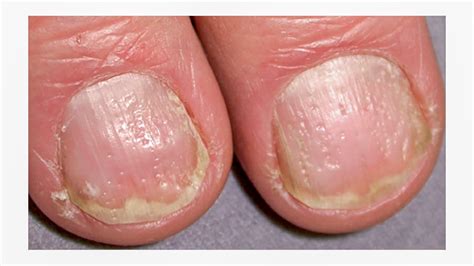 Subungual Hyperkeratosis