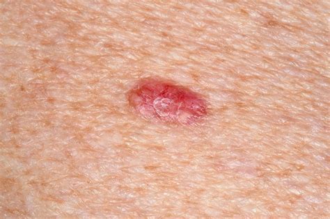 Skin Cancer - Cypress Dermatology