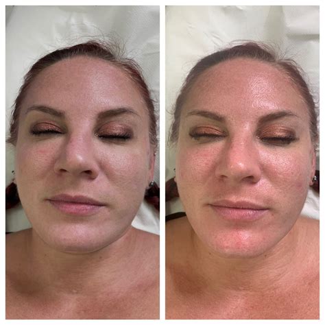 Hydrafacial® Treatment – Rücken – ZZCRLT