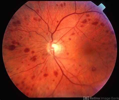 Ocular Ischemic Syndrome (OIS): Navigating Treatment Options