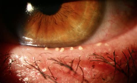 chalazia  meibomian gland dysfunction gp eyes
