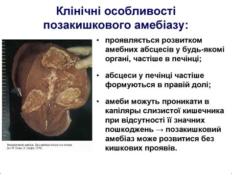 Протозойні інвазії (малярія, амебіаз) - презентация онлайн