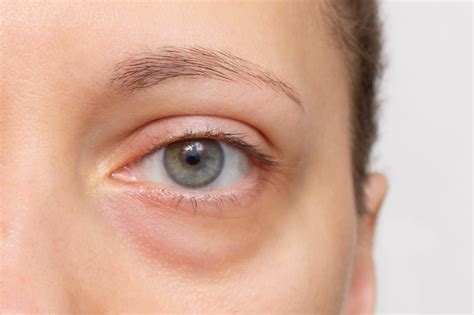 reduce under eye bags 11