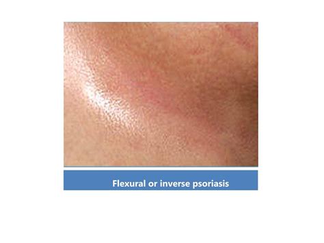 PPT - Psoriasis Treatment in Delhi, India PowerPoint Presentation, free