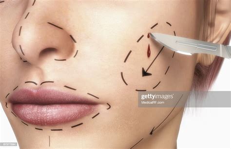 Rhytidectomy High-Res Vector Graphic - Getty Images