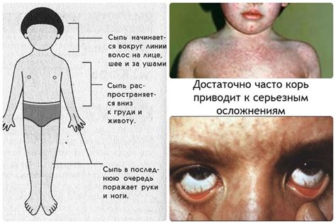 Корь: причины, симптомы, лечение, профилактика